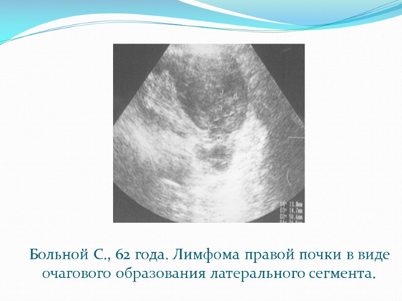 Больной С., 62 года. Лимфома правой почки в виде очагового образования латерального сегмента.